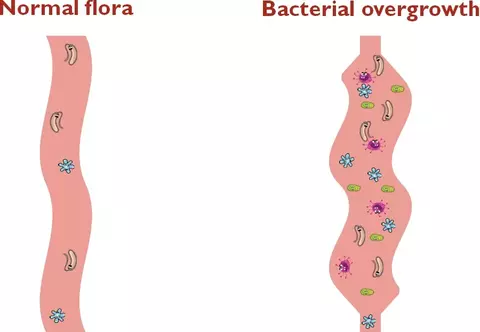Bacterial overgrowth 